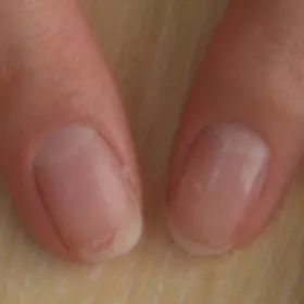 灰指甲致癌吗,灰指甲美甲的禁忌