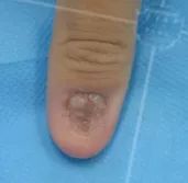 灰指甲致癌吗,灰指甲美甲的禁忌