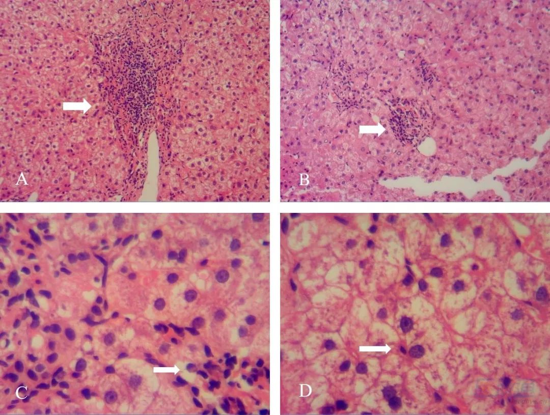 自免肝甲亢,自免肝是不是甲亢引起的