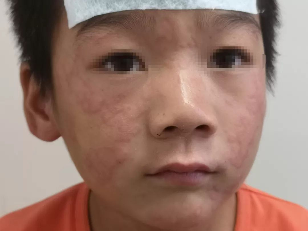 水过敏会引起荨麻疹吗,水过敏皮肤