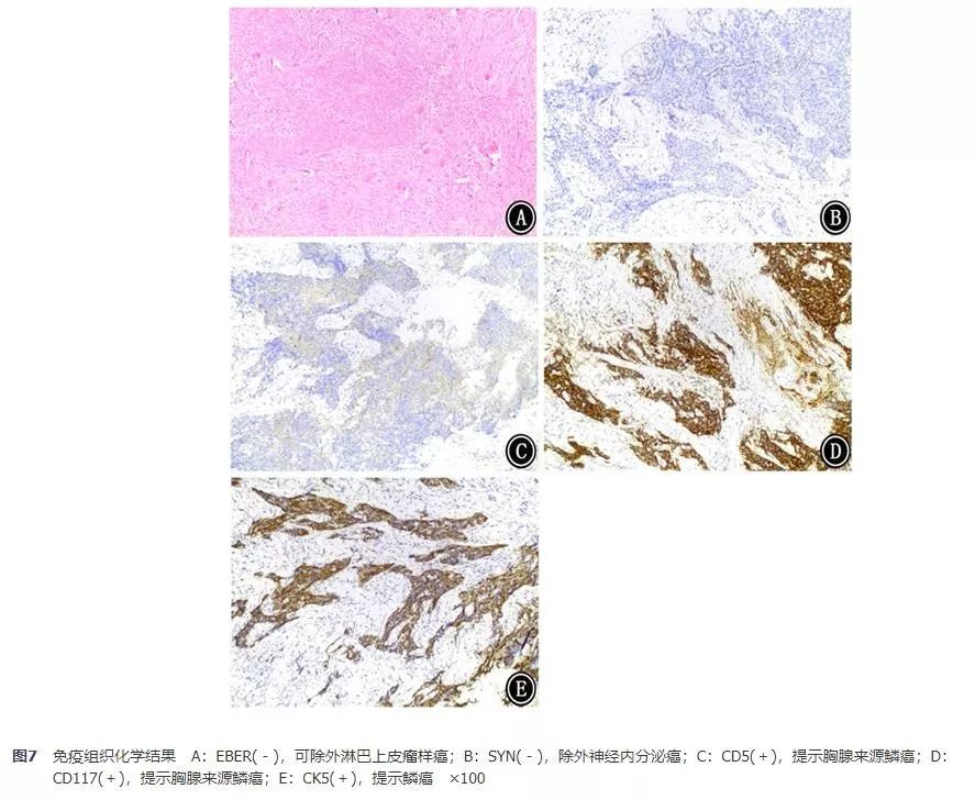 胸腺鳞癌临床出现的几率是多少,胸腺鳞癌一期高分化能活十年吗