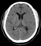 Reco特约·第10期｜国产组合助力取栓“一把通”——Ewata球囊导引导管联合Reco支架取栓分享