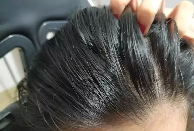 一个月不用洗头快速解决头油头屑,头油头屑多脱发用什么洗