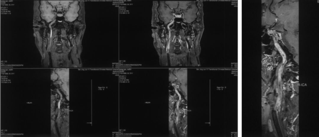 颈内动脉闭塞先进治疗,颈内动脉闭塞开通术病例讨论
