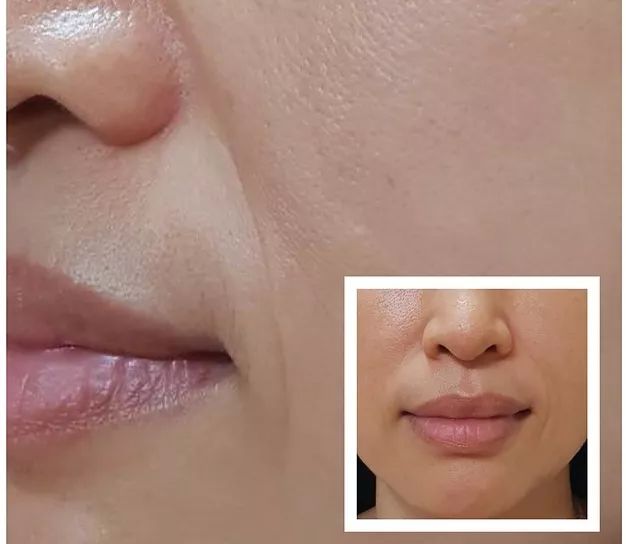 眉间纹和法令纹除皱针能去掉吗,嘴角纹法令纹抬头纹国货推荐