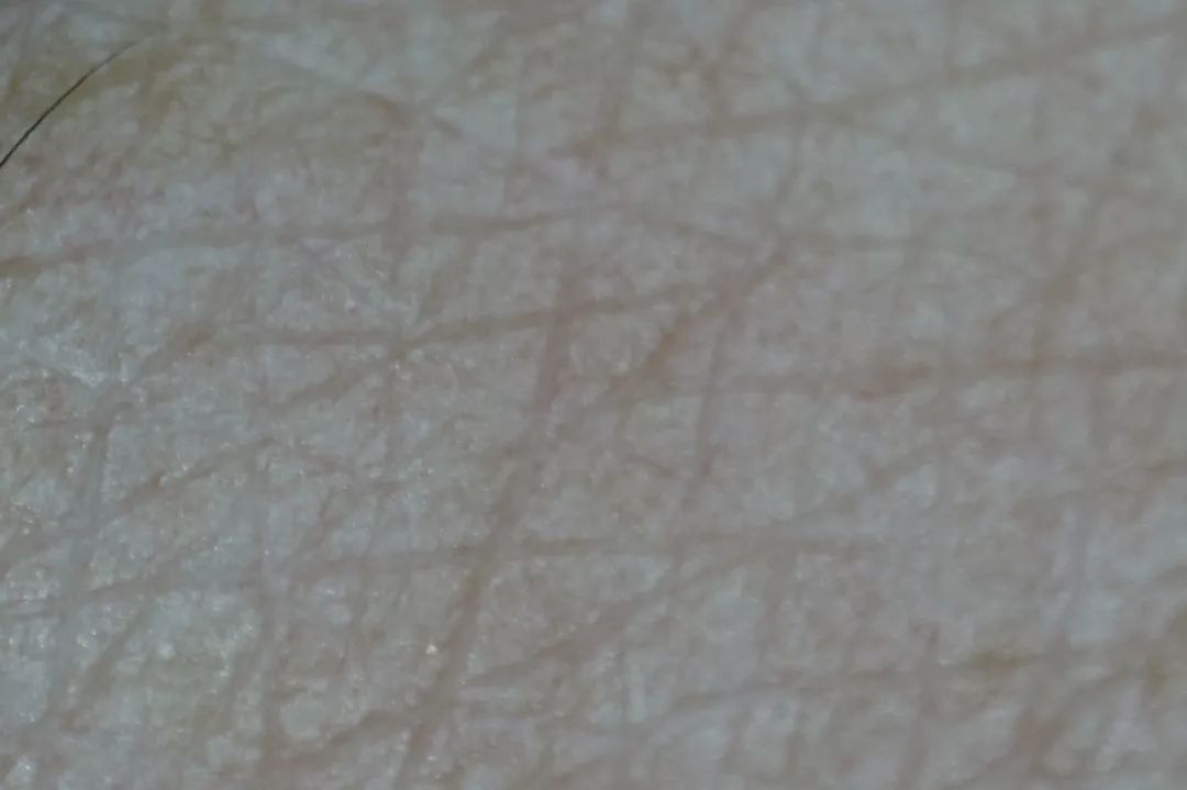 35岁了法令纹鱼尾纹眉间纹怎么办,三十岁就有眉间纹法令纹怎么办