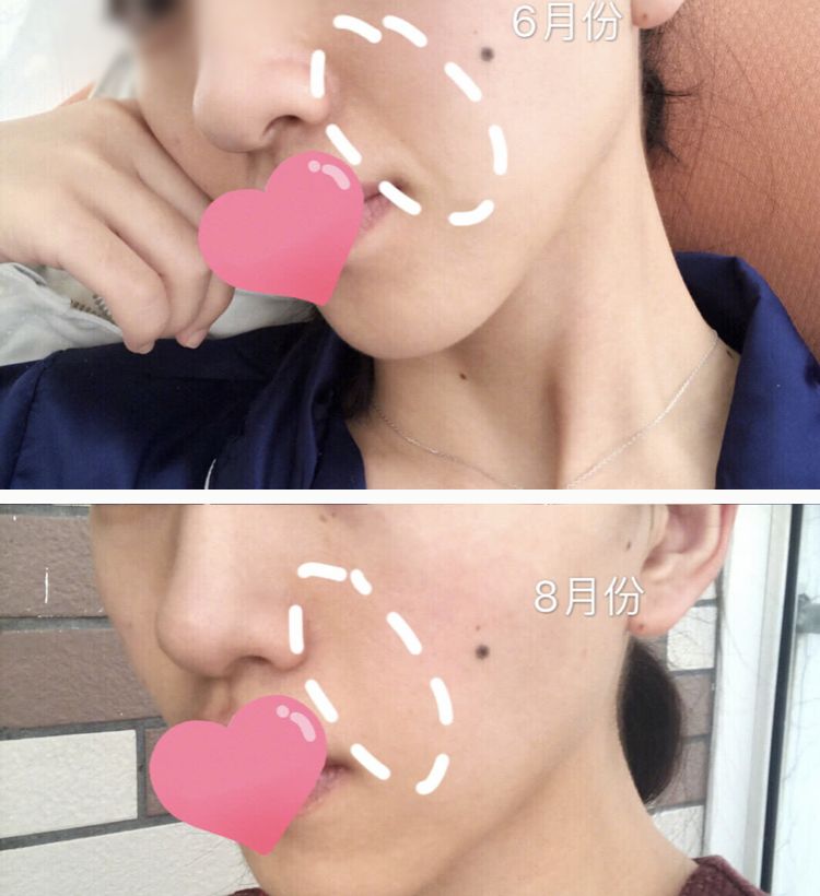 法令纹又黑又长,法令纹又深又长好吗