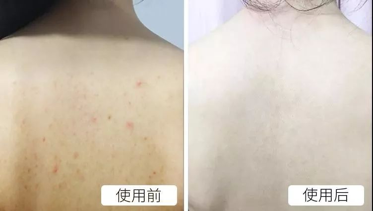 可美金箔祛痘螨虫皂,除螨皂能祛螨虫吗