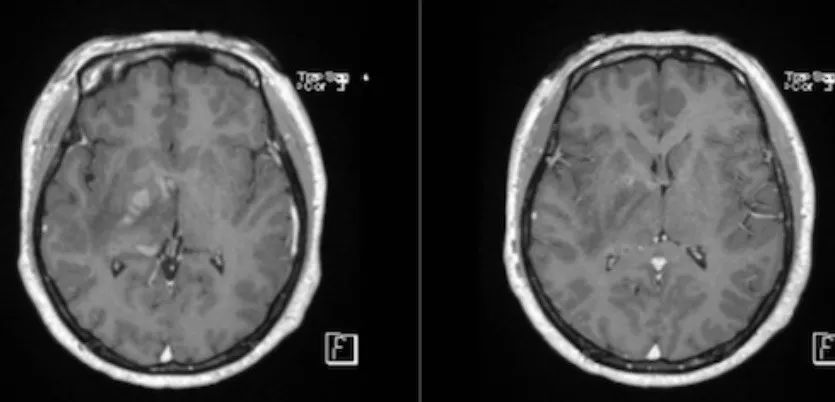 急性脂肪栓塞、神经白塞病、NMOSD极后区综合征丨3分钟读片·第11期