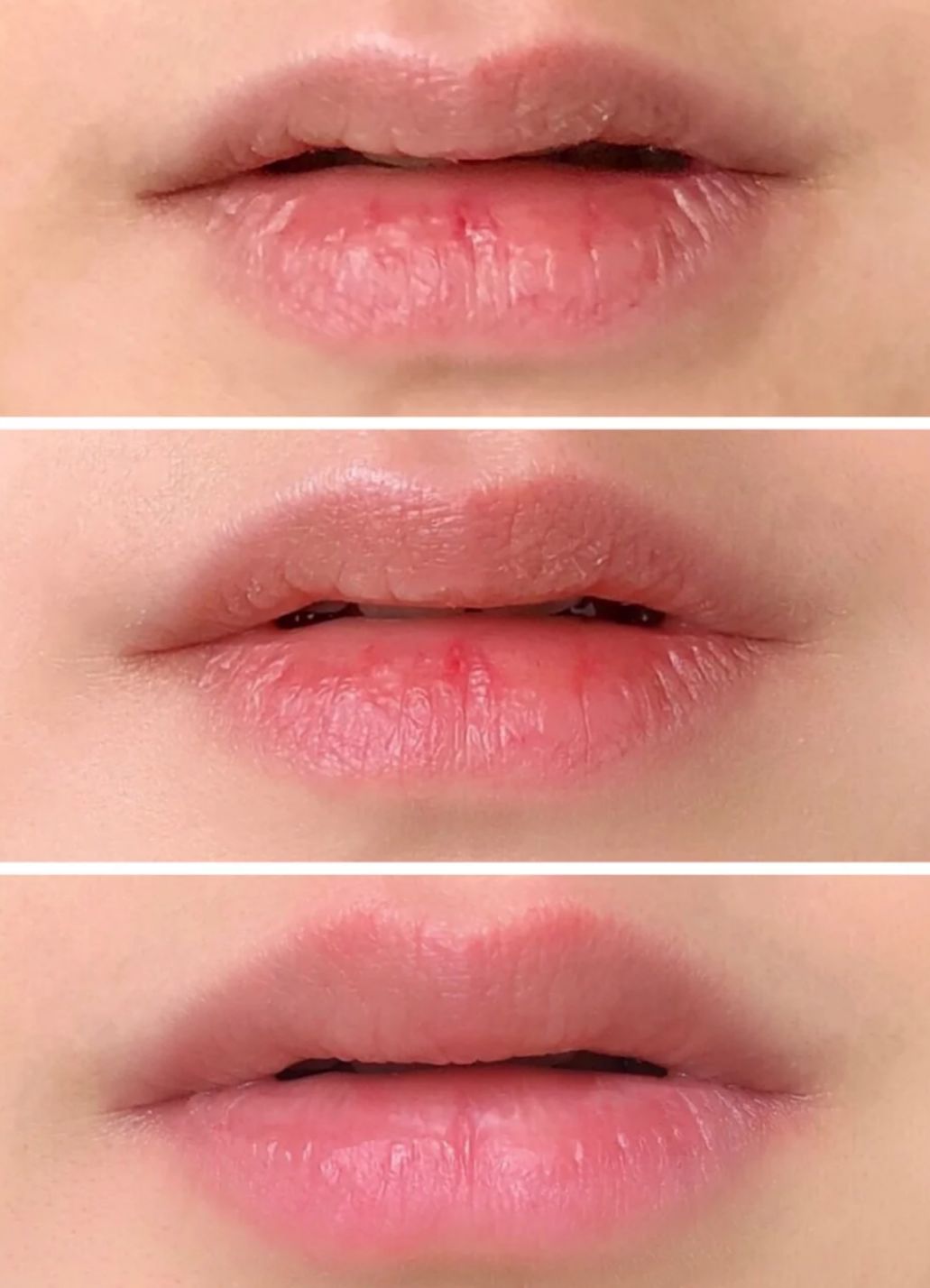 薄唇如何丰唇好看,丰唇使嘴唇变得更美