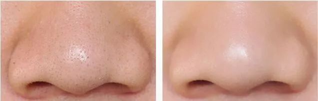 痘痘闭口里面有油脂,鼻子上的痘痘是青春痘还是粉刺