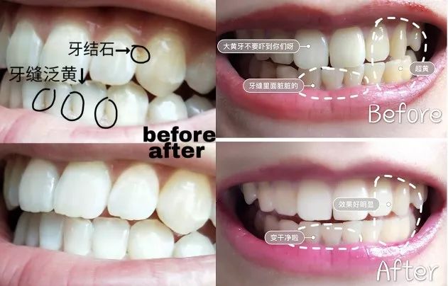 牙龈上火、红肿，还口臭？香港人用了91年的中药牙膏，消炎抑菌，让你刷出一口健康好牙