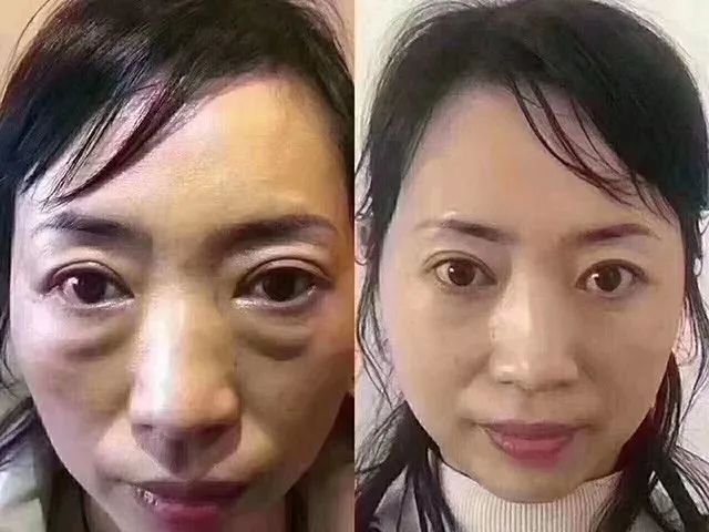 眼袋松弛下垂最快解决方法,严重眼袋下垂松弛怎么恢复