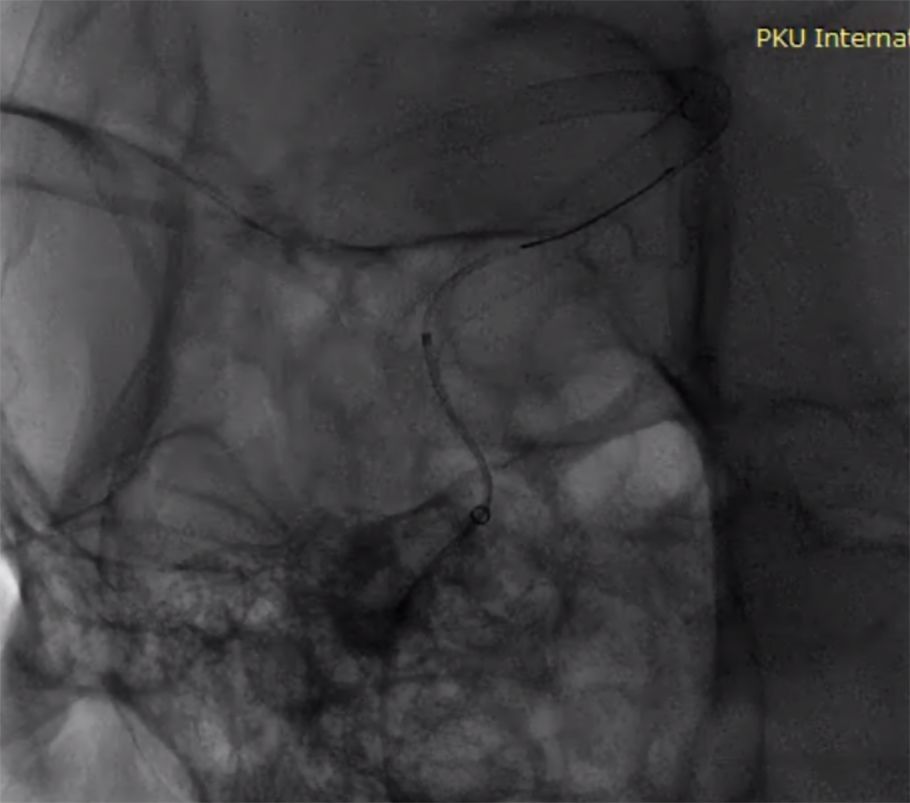 物华天宝·第7期｜脑部长型巨大夹层动脉瘤的4个密网支架桥接治疗复查治愈（附复查CTA结果）