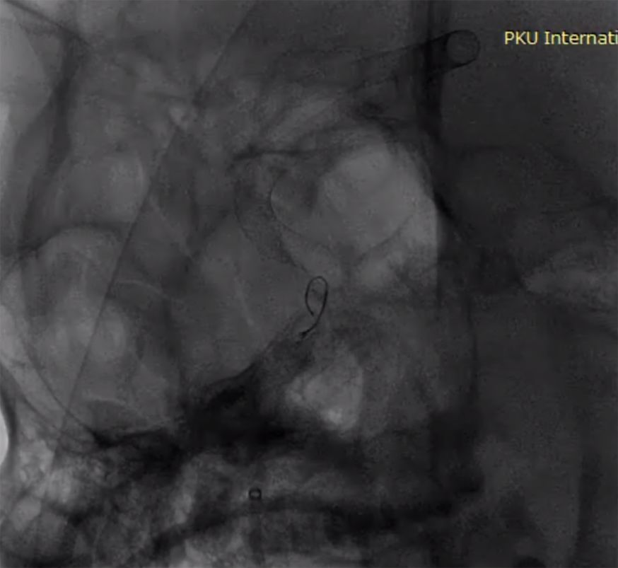 物华天宝·第7期｜脑部长型巨大夹层动脉瘤的4个密网支架桥接治疗复查治愈（附复查CTA结果）