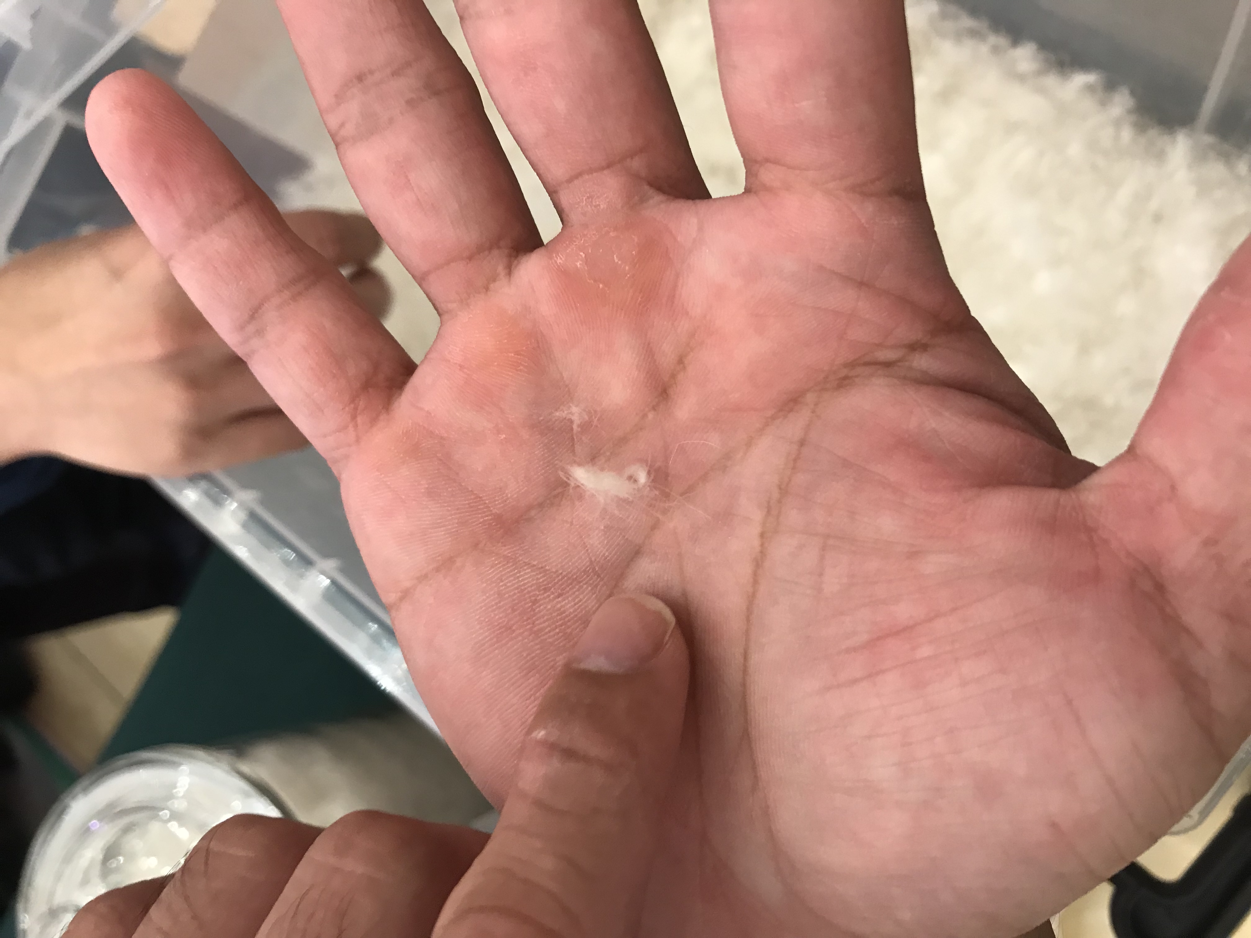 羽绒过敏,劣质羽绒服会过敏吗