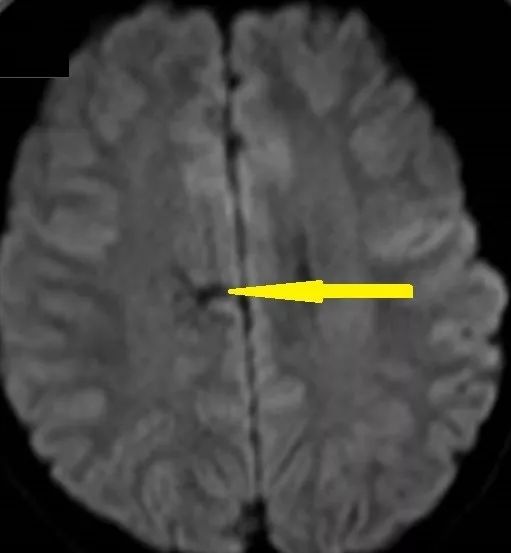 Rasmussen脑炎、结核性肉芽肿、脑发育性静脉畸形丨3分钟读片·第13期,下)