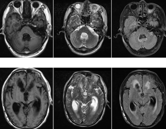 Rasmussen脑炎、结核性肉芽肿、脑发育性静脉畸形丨3分钟读片·第13期,下)