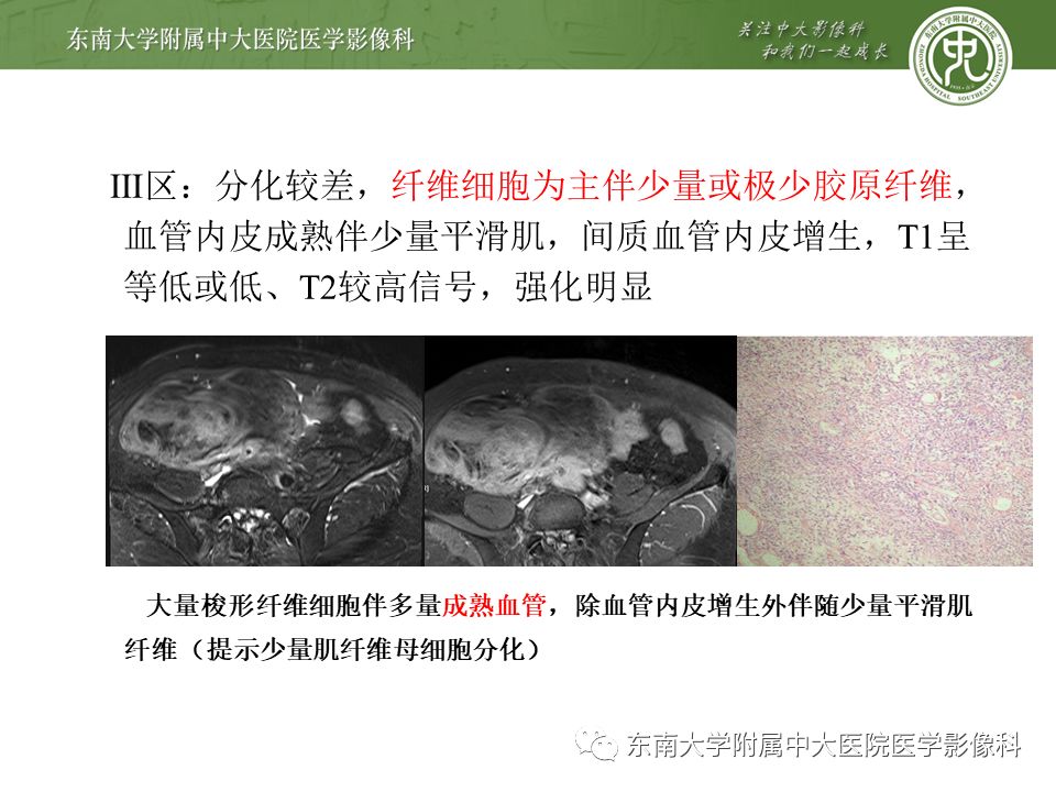 侵袭性纤维瘤影像学表现,侵袭性纤维瘤病影像上易诊断吗