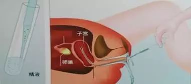 人工授精是看妇科还是生殖科,生殖科人工授精的方法
