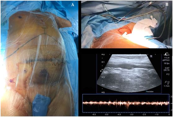 超声引导下腋静脉穿刺技巧,起搏器腋静脉穿刺操作步骤