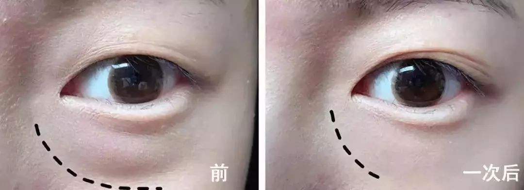 解决眼袋只需3步,不管眼袋多严重用点它