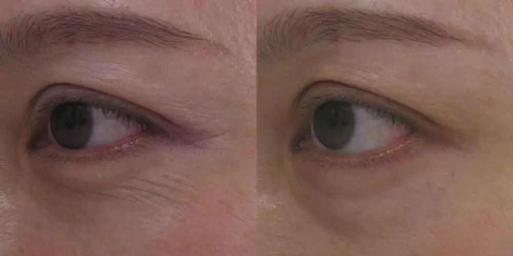 蛋白贴去皱,胶原蛋白颈纹贴