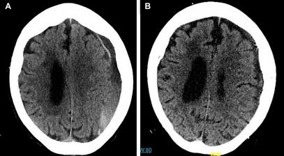 慢性硬膜下血肿会复发吗,慢性硬膜下血肿为什么容易复发