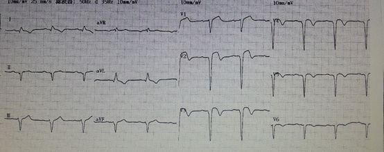 缺血性心肌病心衰恢复,缺血性心衰能逆转吗