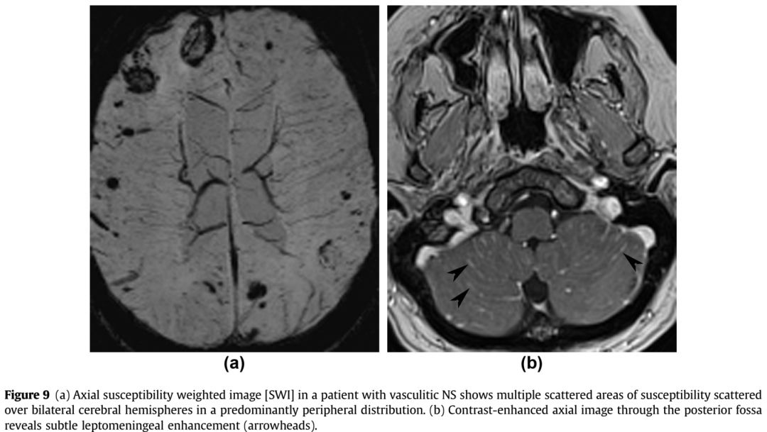 Whipple病、纹状体手、神经结节病、脱髓鞘假瘤丨3分钟读片·第16期