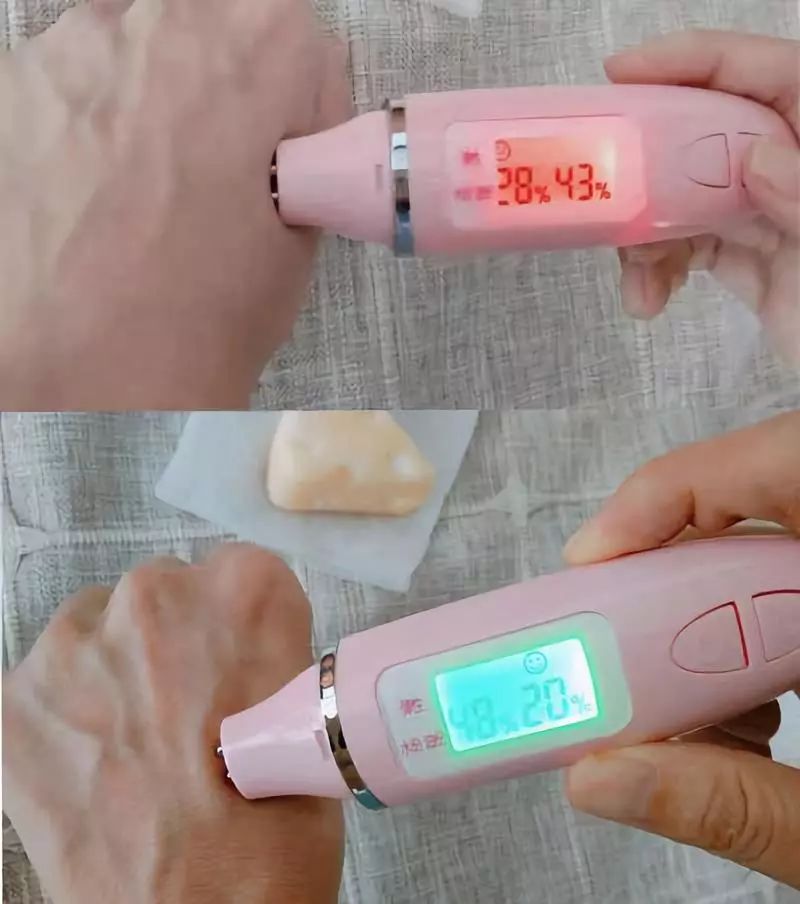 痘痘闭口里面有油脂,鼻子上的痘痘是青春痘还是粉刺