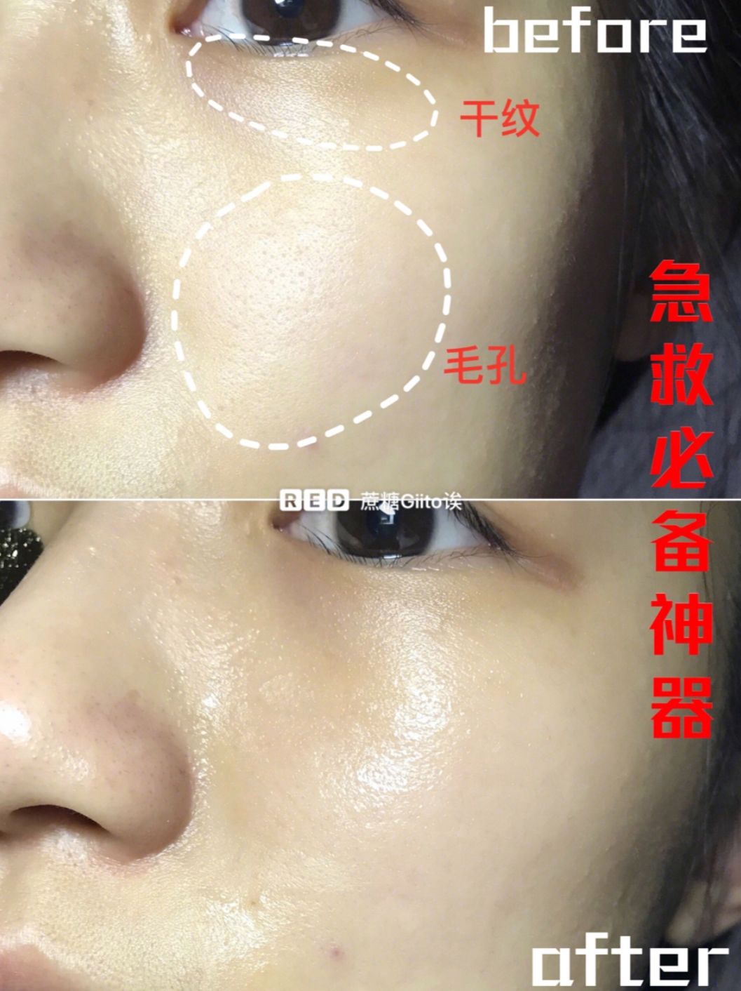 法令纹眼纹一个都逃不掉,法令纹和眼纹怎么才能有效改善