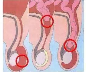 勿以“疝”小而不为，也有可能随时会要命