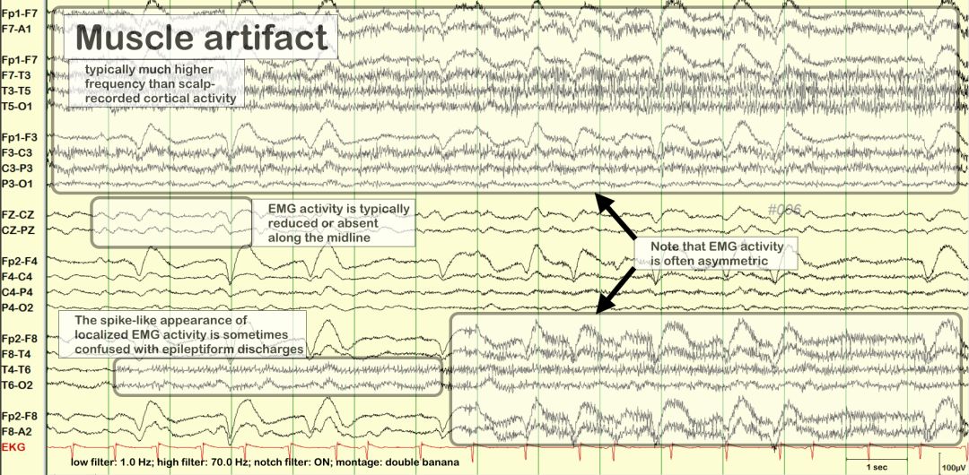 脑电图伪差图,脑电图伪差图谱