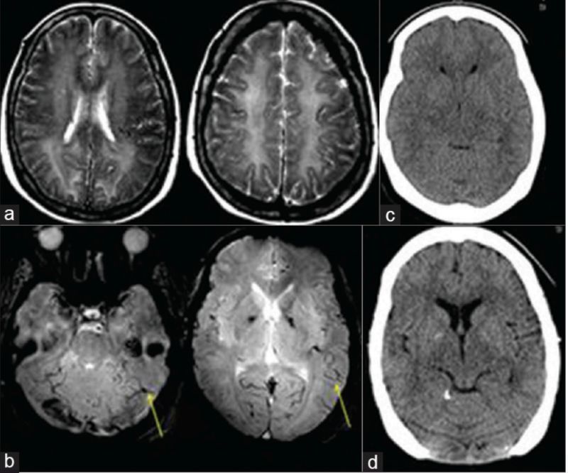 高氨血症有哪些表现,高氨血症