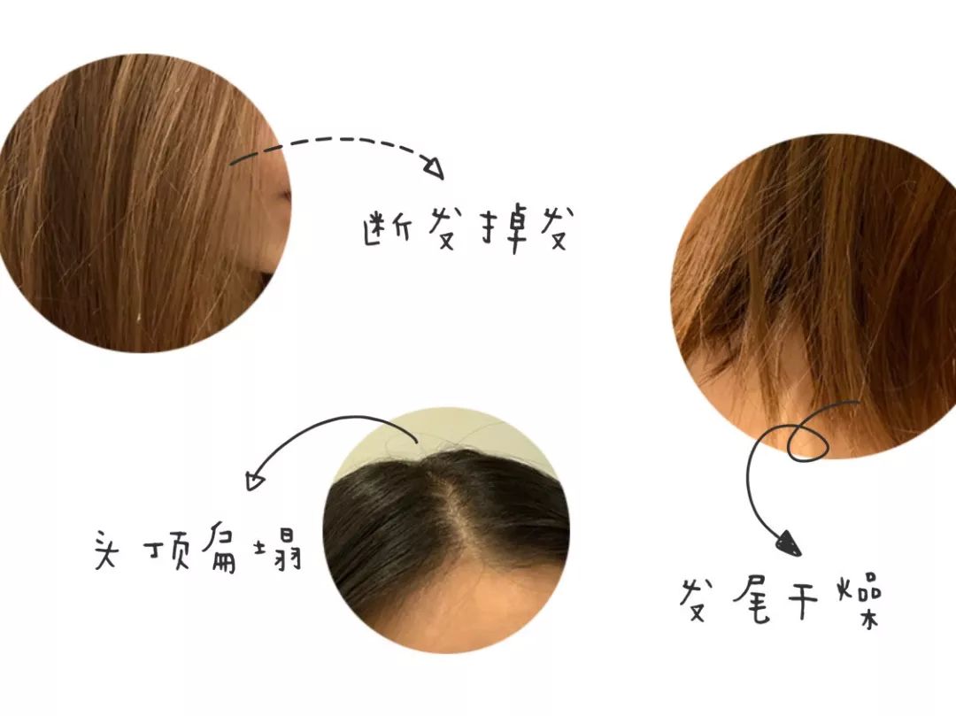 防脱发最好的科普,防脱发自救指南