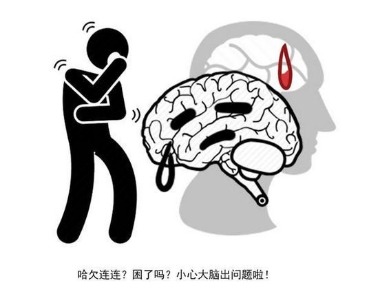 出现这四个症状就是脑梗的征兆了,轻微脑梗的症状与治疗方法是什么