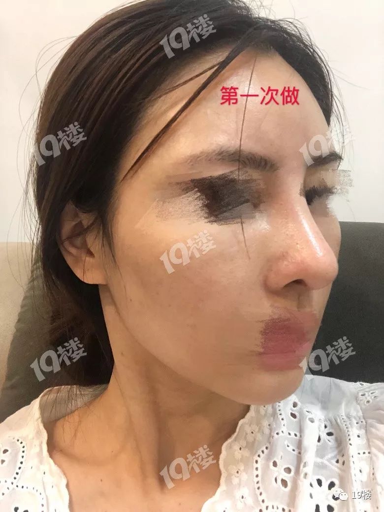 美丽女子整容失败,鼻整形失败多久可以修复