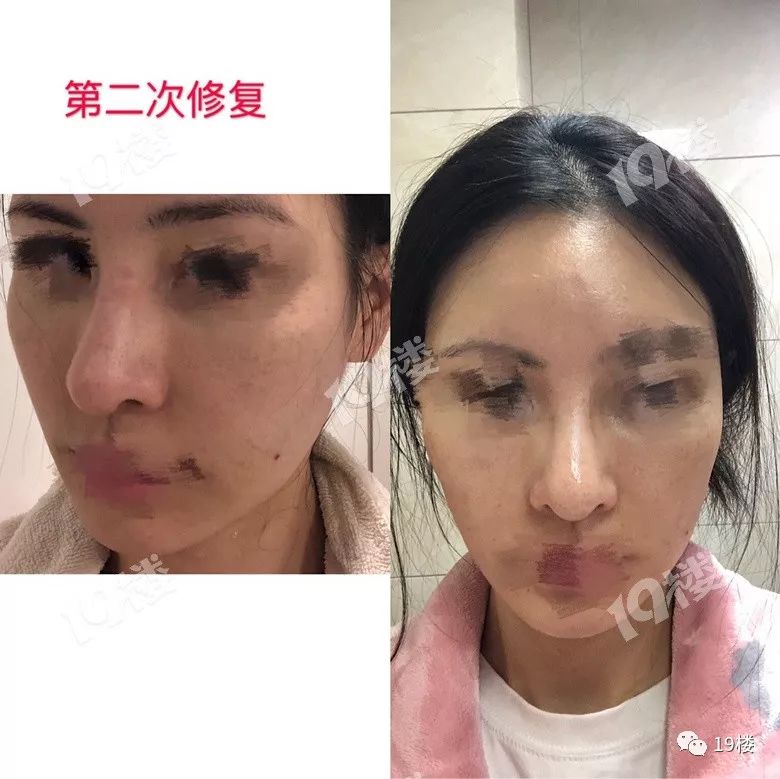 美丽女子整容失败,鼻整形失败多久可以修复