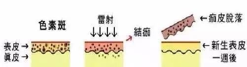 褐青色痣和斑的区别,褐青色痣斑是怎么形成的