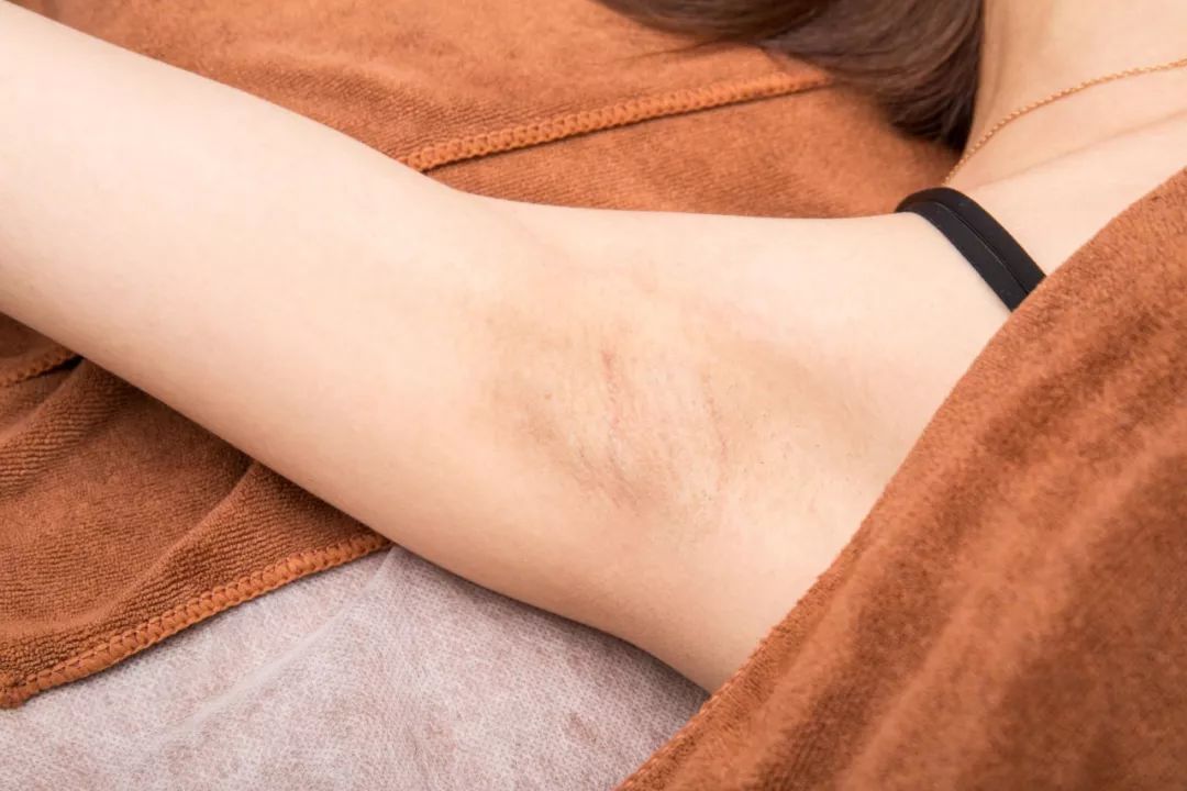 脱毛是不是秋冬季最适合,夏季脱毛便宜的方法有哪些