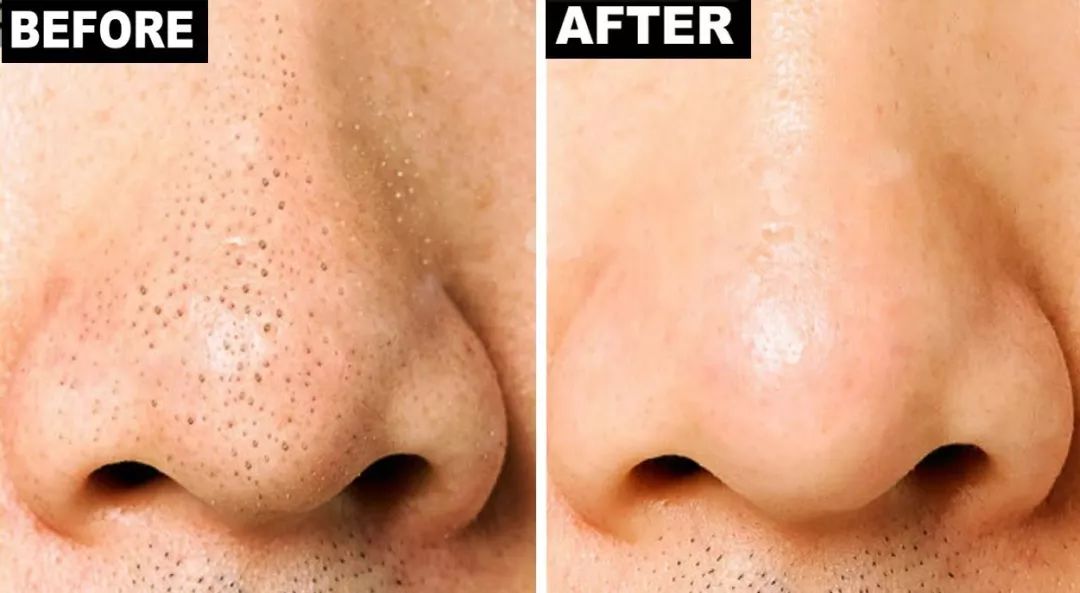 脸上搓出3斤泥!难怪又黄又暗又黑头!10秒给脸蛋“剥壳”,厉害