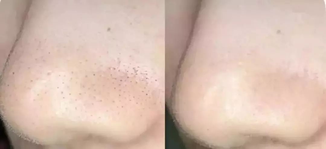 脸上搓出3斤泥!难怪又黄又暗又黑头!10秒给脸蛋“剥壳”,厉害