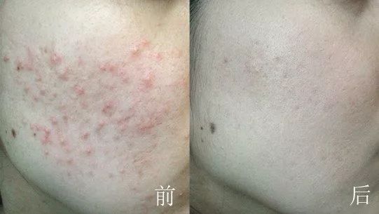 团|墙上插上它，24小时物理除螨，让千万螨虫集体自杀，比太阳暴晒强10000倍