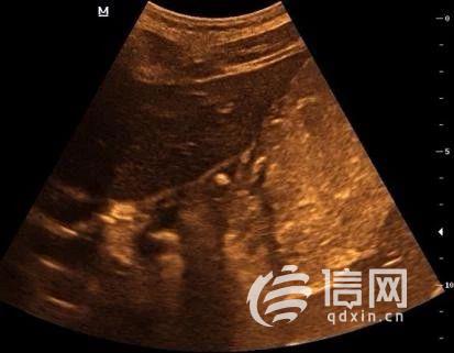 高中女生不明原因肚子疼,中学女孩胃疼