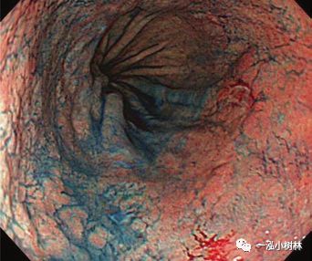 消化道早期癌内镜诊断技巧图谱,早期消化道肿瘤内镜下黏膜剥离术