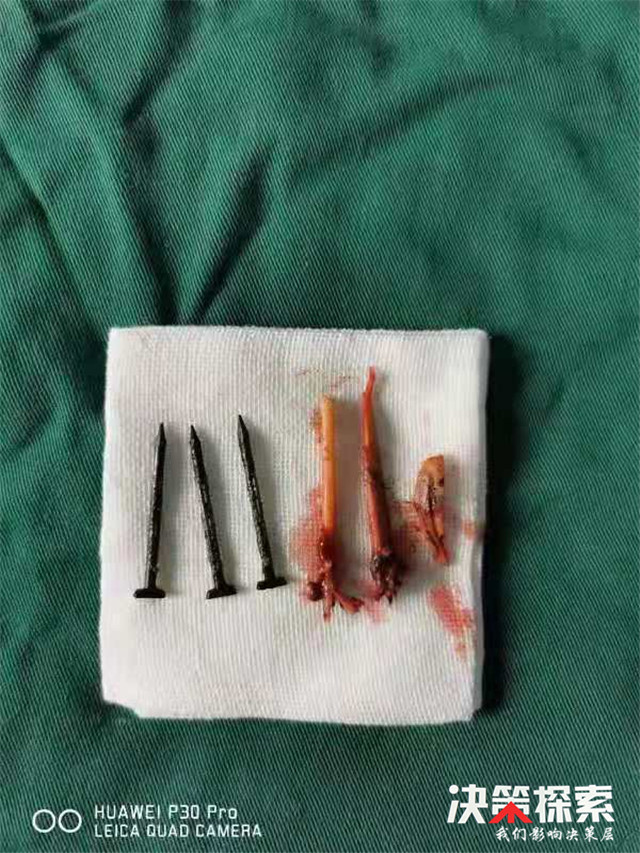 心焦！南阳一小伙因牙疼难忍，竟将铁钉牙签棍儿等插入牙床“钉灸”……