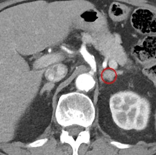 在线心内会诊室丨原醛治疗,“柳暗花明又一村”