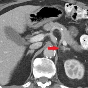 在线心内会诊室丨原醛治疗,“柳暗花明又一村”