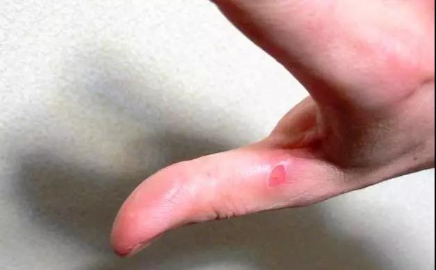 儿童开水烫伤急救处理,被开水烫伤怎么办最快最有效